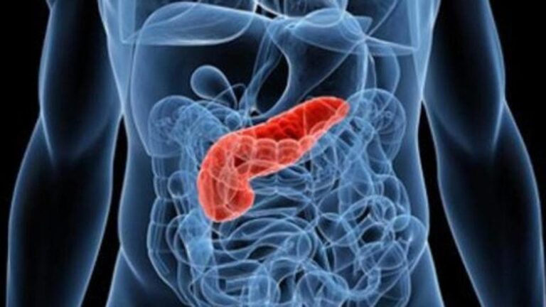 Tumore al pancreas, individuata proteina che ne favorisce la crescita