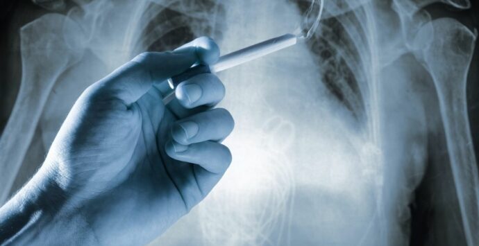 Tumore al polmone, drastico calo dei morti con screening Tac bassa dose