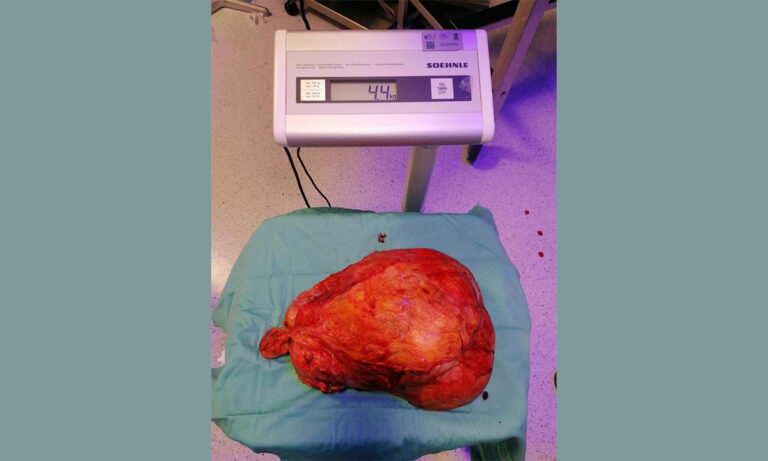 Ospedale di Cosenza, intervento da record: asportato un tumore di 4 chili e mezzo